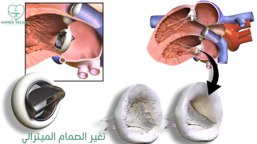 تغيير الصمام الميترالي بدون جراحة 