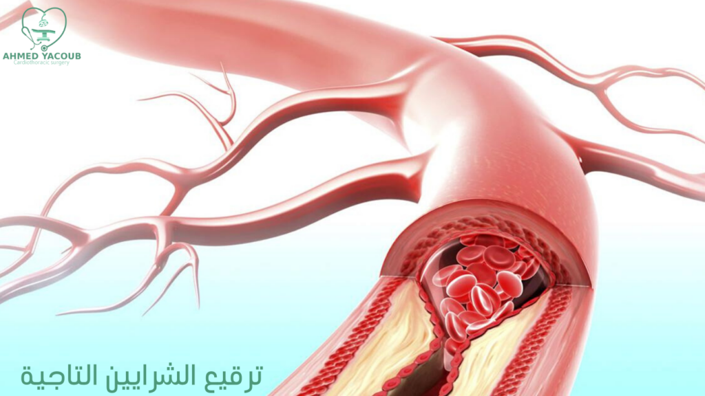 عملية ترقيع الشرايين التاجية