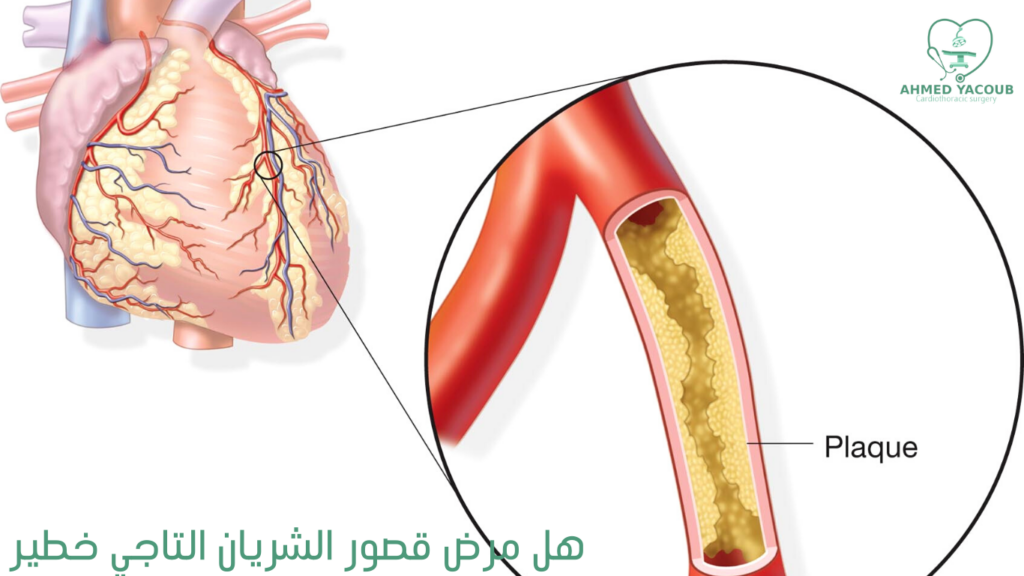 هل مرض قصور الشريان التاجي خطير؟