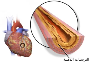 علاج انسداد الشريان التاجي بدون جراحة 