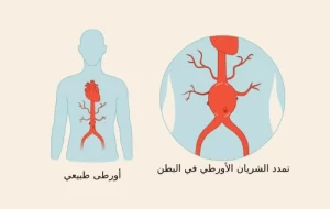 علاج تمدد الشريان الأورطي البطني