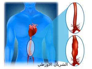 نسبة نجاح عملية الشريان الاورطي