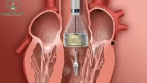 عملية تغيير صمام القلب بالمنظار