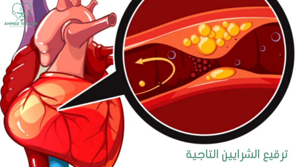 عمليات ترقيع الشرايين التاجية