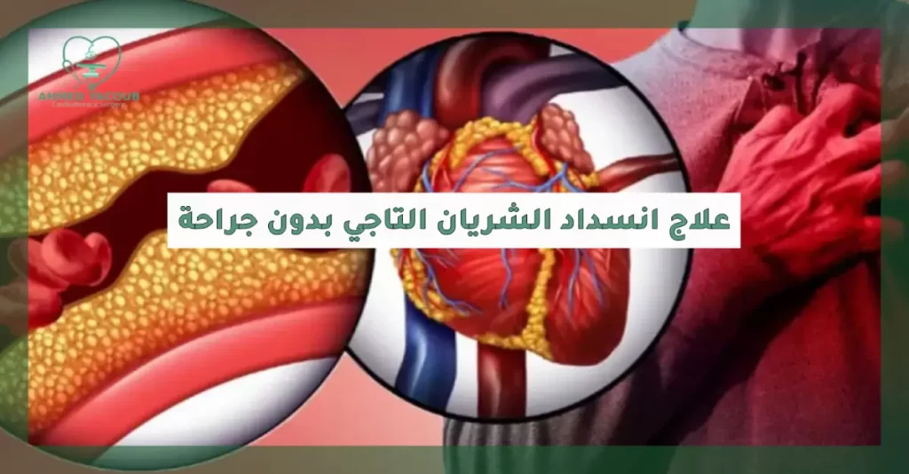 علاج انسداد الشريان التاجي بدون جراحة