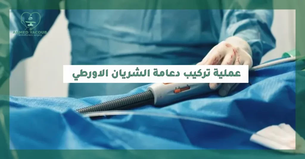 عملية تركيب دعامة الشريان الاورطي