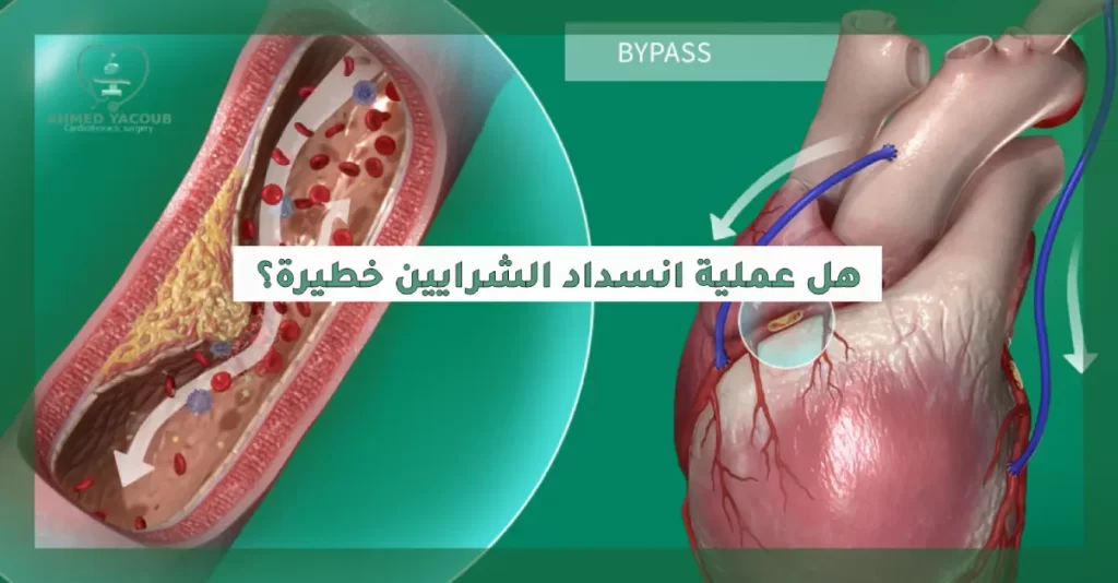 هل عملية انسداد الشرايين خطيرة؟