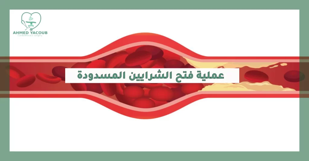 عملية فتح الشرايين المسدودة