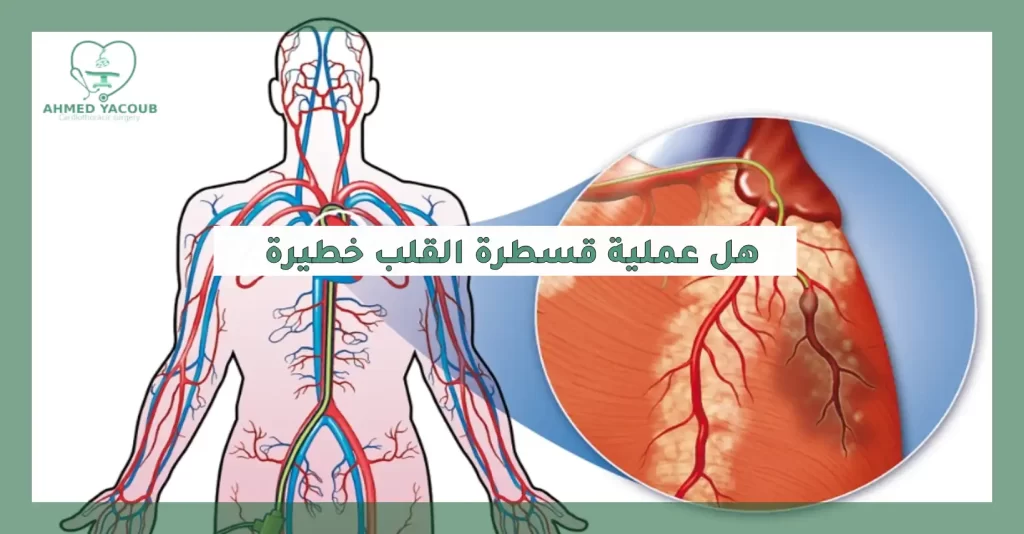 هل عملية قسطرة القلب خطيرة